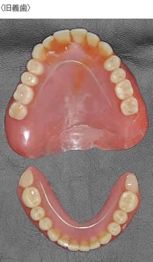 旧義歯イメージ